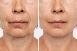 before-after-cosmetic-operation2-300x199
