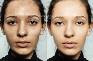 before-after-cosmetic-operation5-300x199 (1)